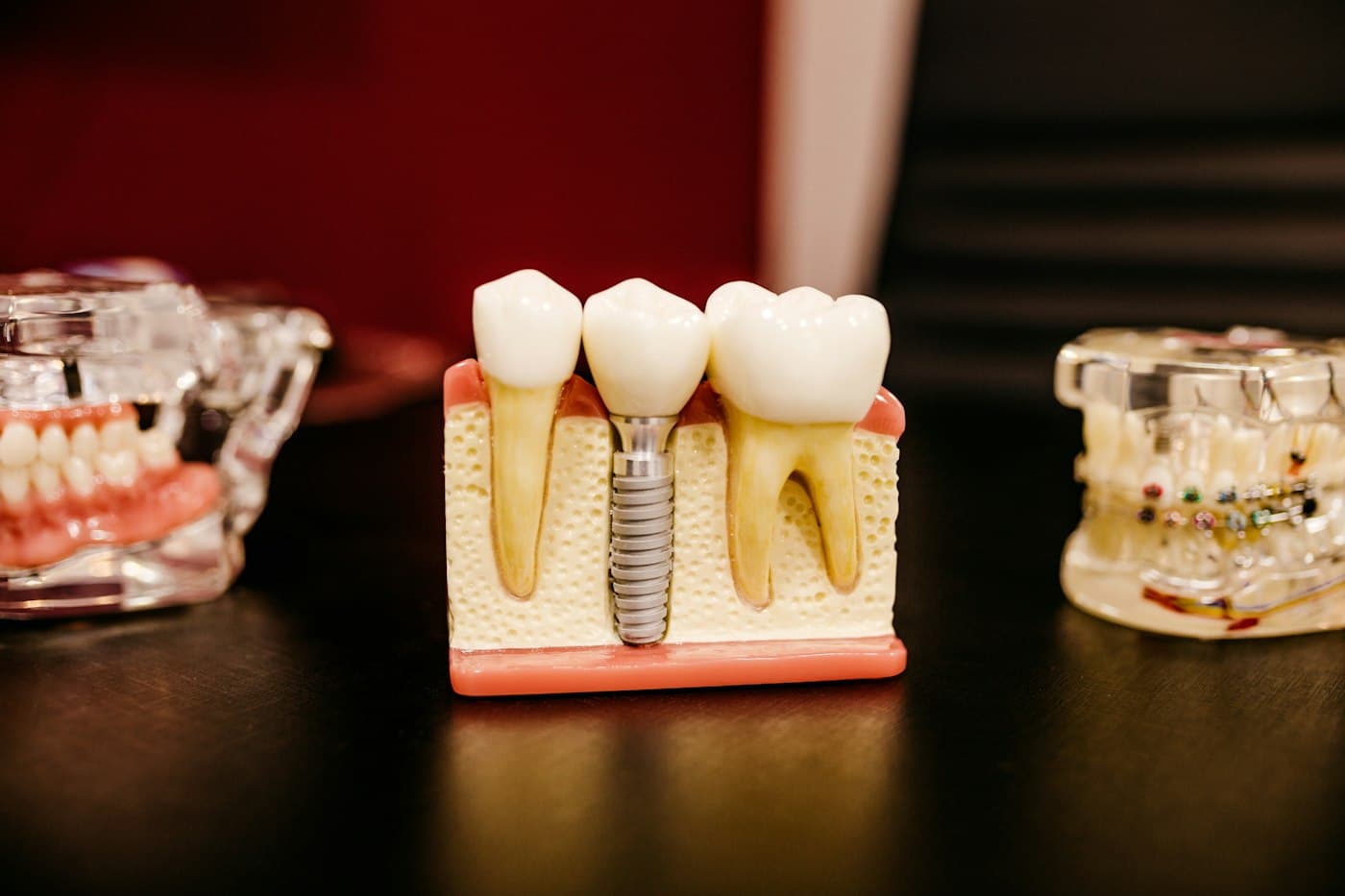 Model of a dental implant beside natural teeth